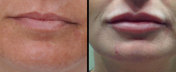 Before and after lip augmentation, showing changes in size and shape.
