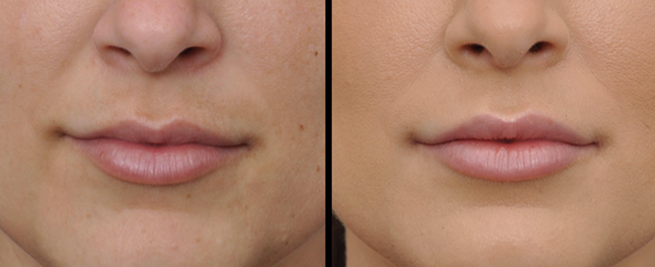 Before and after of a person's lips. The lips are fuller and more defined in the 