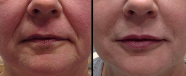 Side-by-side view of a person's lower face. The left side shows visible wrinkles. The right side shows smoother skin.