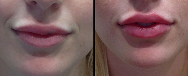 Before and after of lips, left side is thinner, right side has full lips.