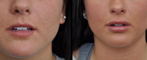 Side-by-side view of a person's lips before and after a lip enhancement procedure.