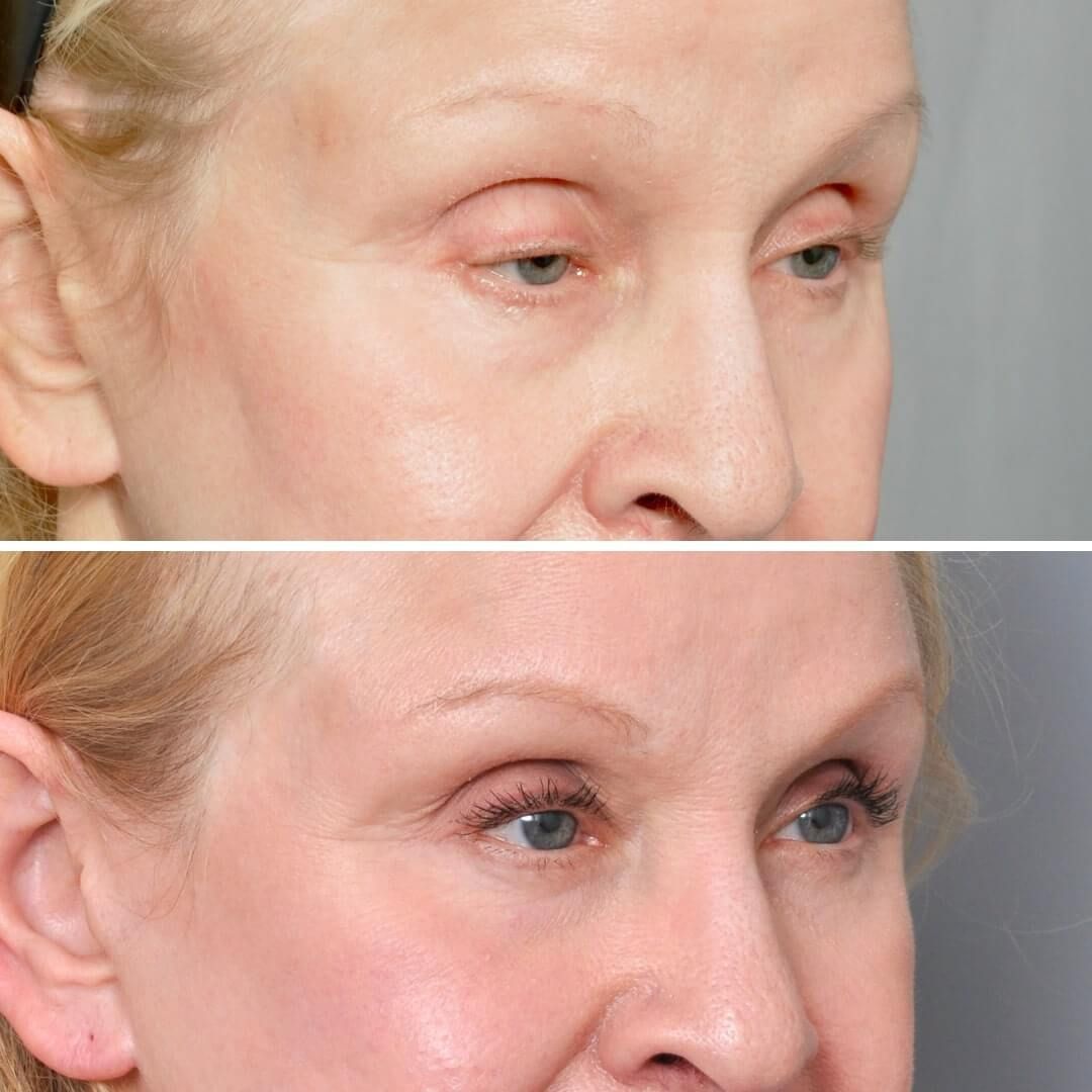 Before-and-after of a person's eyes, showing a reduction in upper eyelid droopiness.