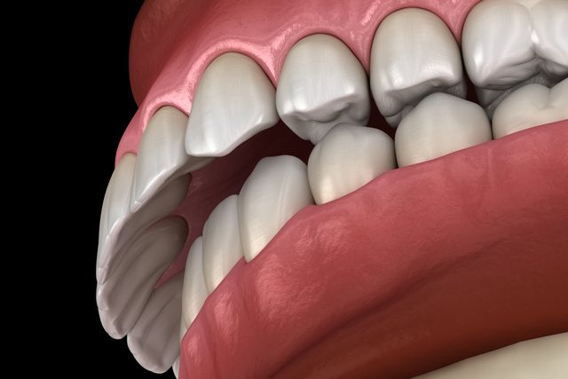 What Is An Overbite & How To Correct It