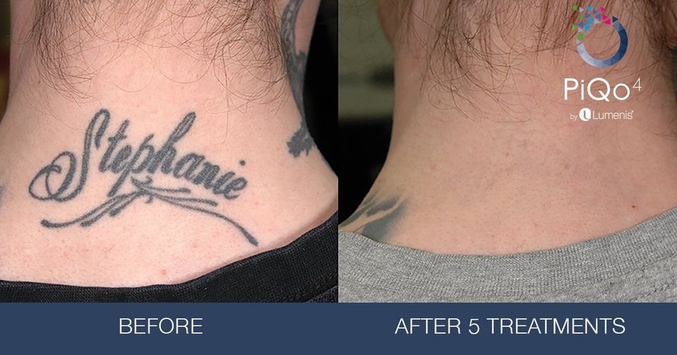 Laser Tattoo Removal | PiQo4 Treatment | Seattle Dermatology