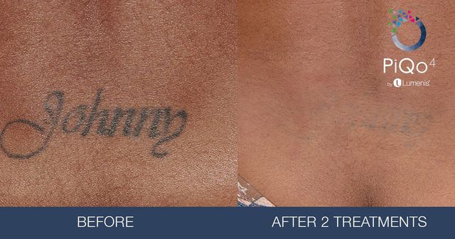 Revolutionary PicoSure Laser Provides the Fastest Tattoo Removal With  Dramatic Groundbreaking Results