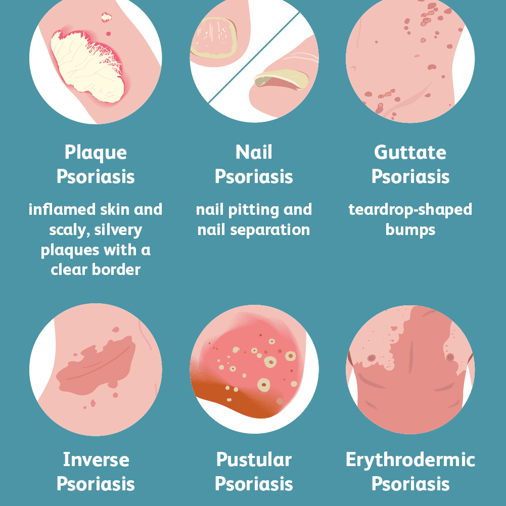 Chronic Plaque Psoriasis Causes Symptoms And Treatment Psoriasis Chronic Plaque Psoriasis Causes Symptoms And Treatment Psoriasis