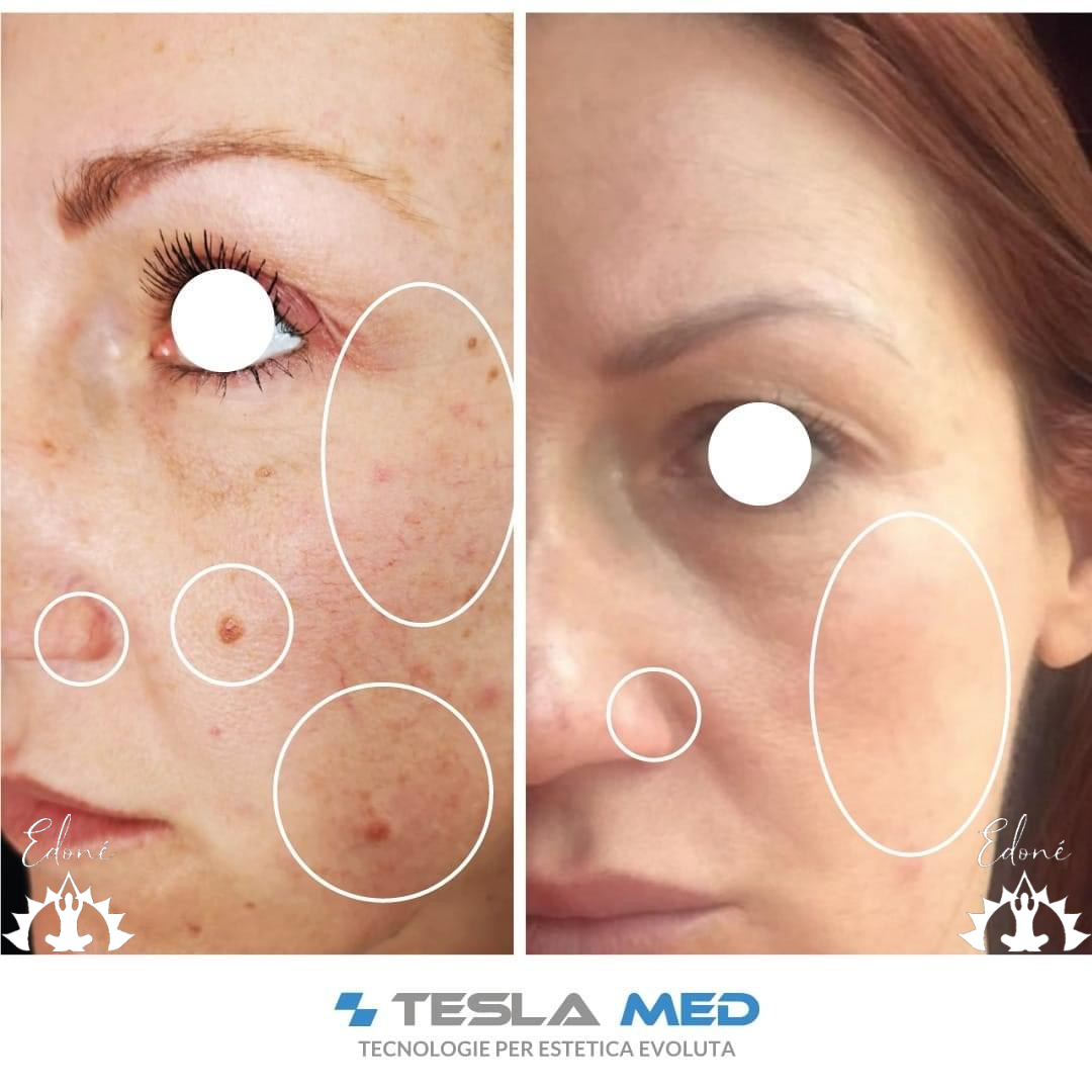 rimozione angiomi rubino