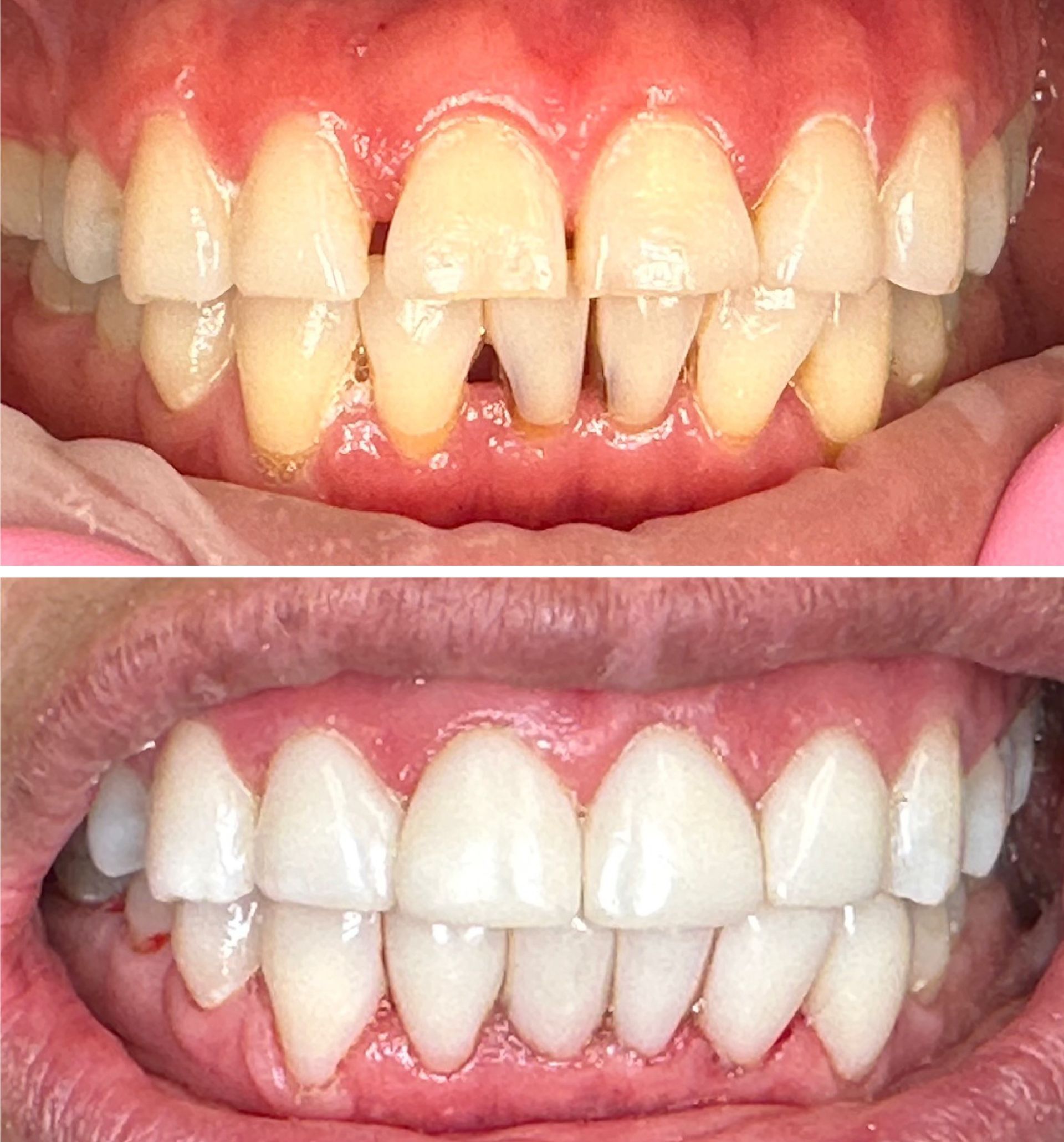 Before and after comparison of teeth. The before image shows yellowed teeth with gaps, the after image shows straight white teeth.