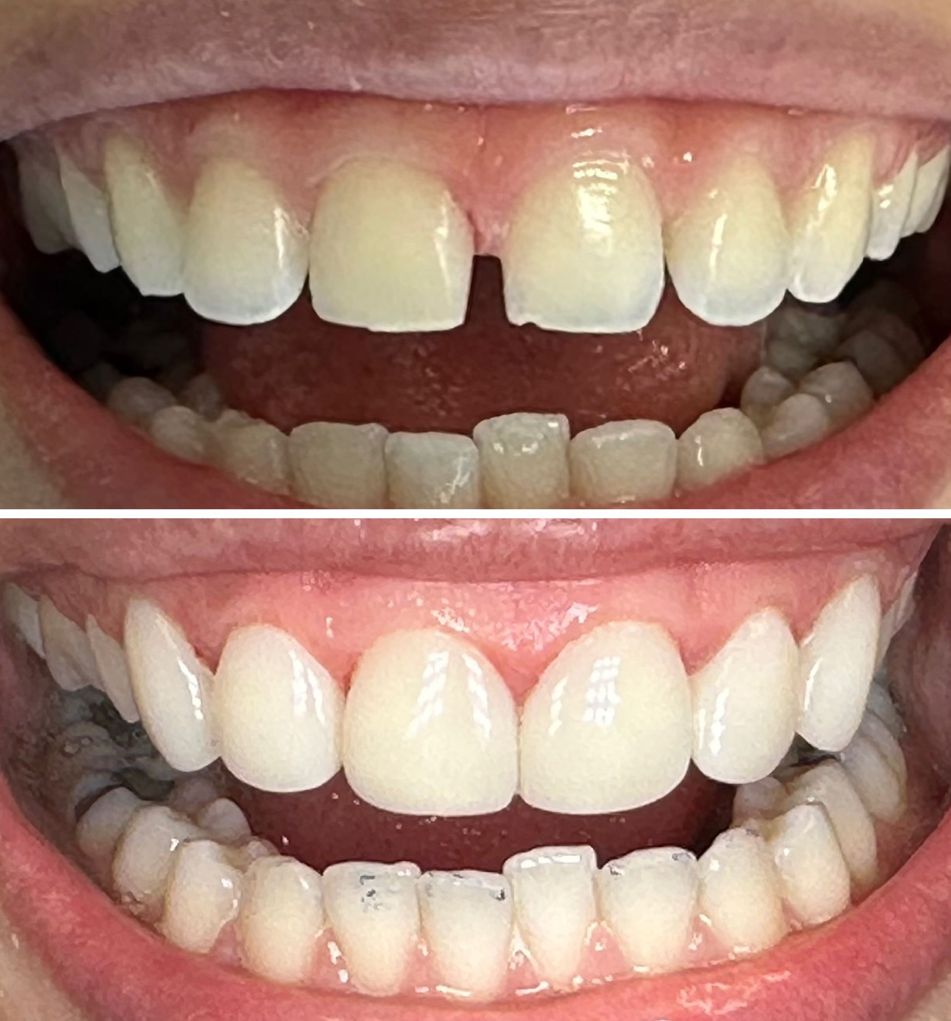 Before and after dental work: Close-up of teeth showing a gap closed and teeth whitened.