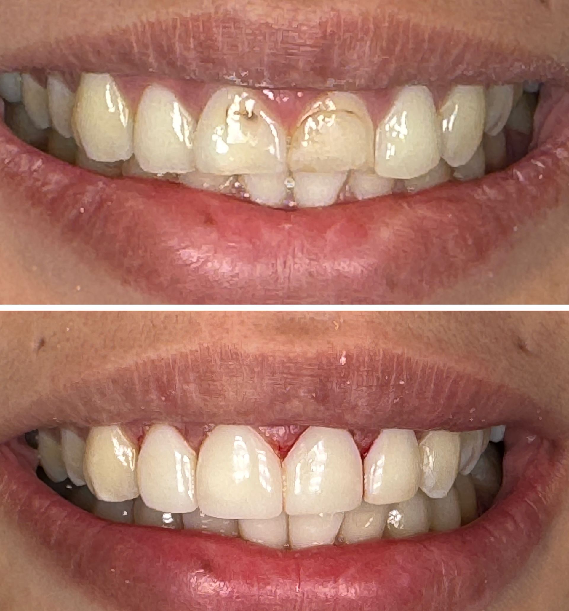Top: Damaged teeth with discoloration. Bottom: Restored, bright white teeth in a smiling mouth.