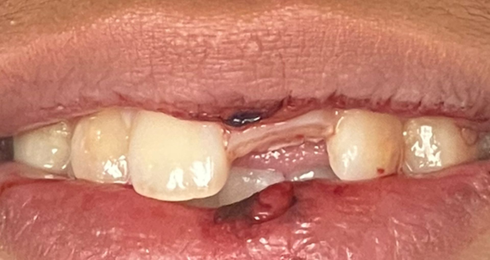 Close-up of a person's teeth showing a gap between the front teeth, and a pink gum line.