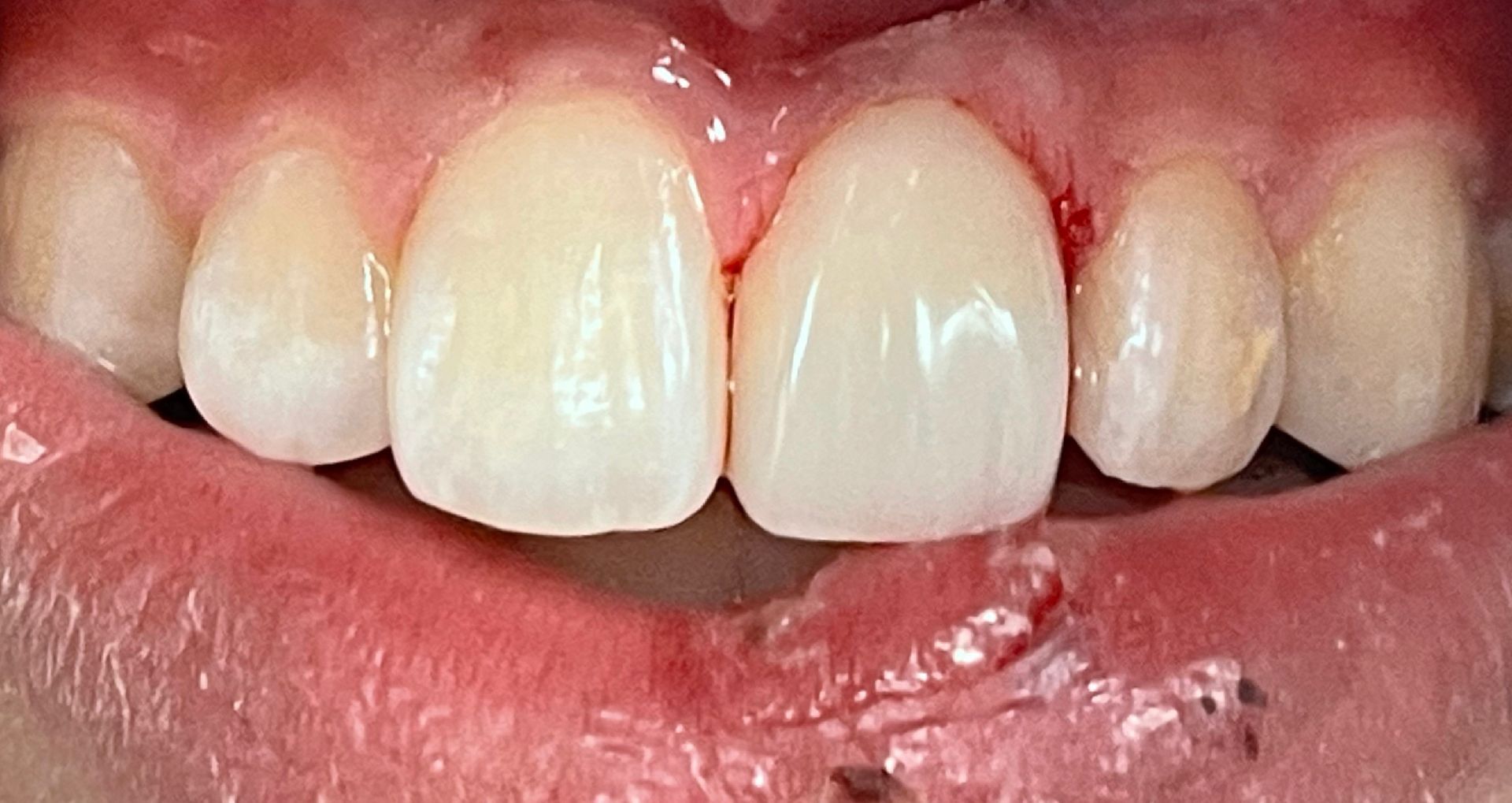 Close-up of an open mouth showing upper and lower teeth, some with dental work, against pink gums.