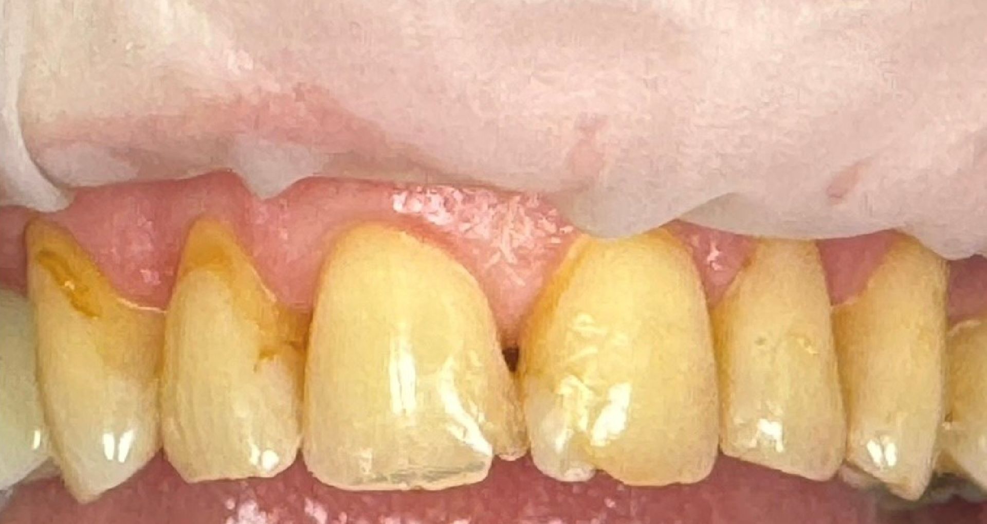 Close-up of a person's teeth showing a gap between the front teeth, and a pink gum line.