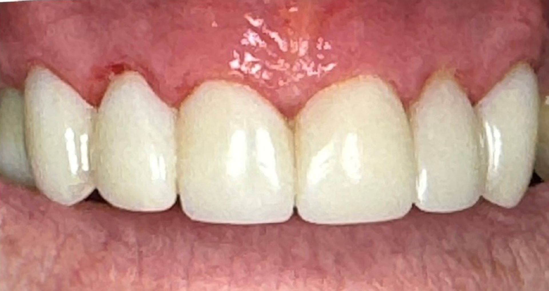Close-up of an open mouth showing upper and lower teeth, some with dental work, against pink gums.