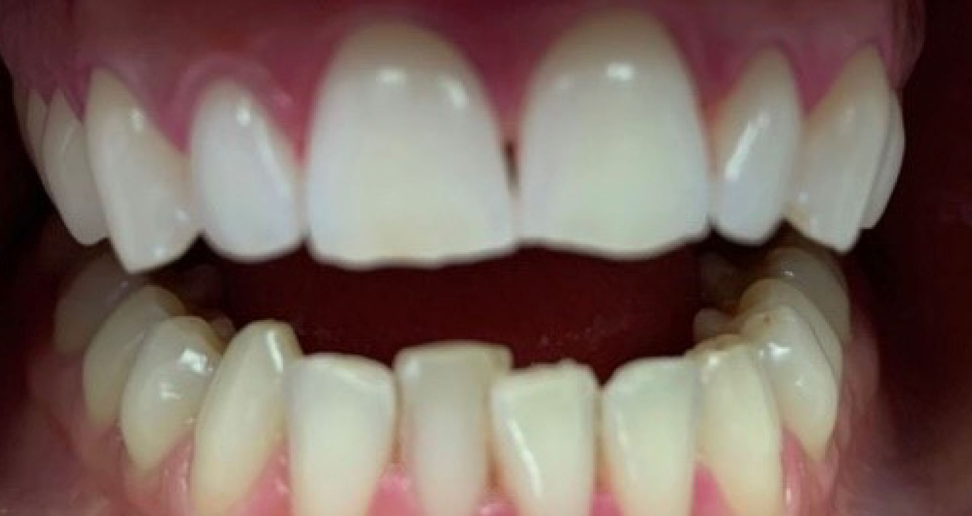 Close-up of a person's teeth showing a gap between the front teeth, and a pink gum line.