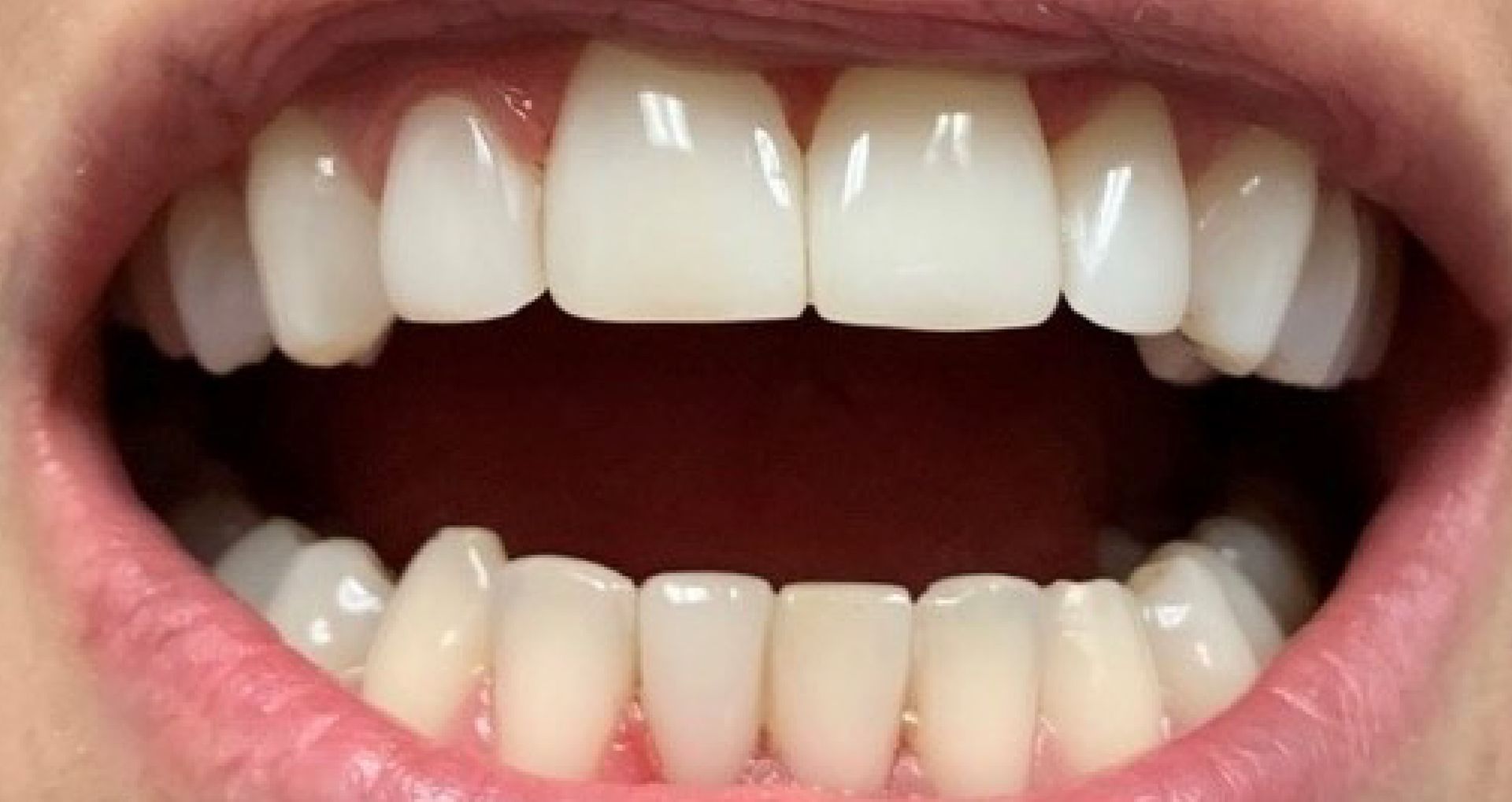 Close-up of an open mouth showing upper and lower teeth, some with dental work, against pink gums.