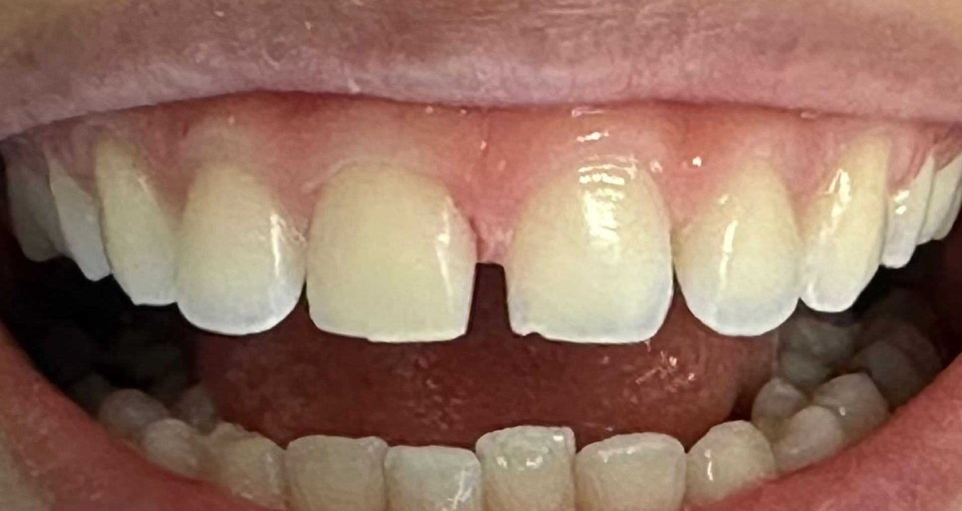 Close-up of a person's teeth showing a gap between the front teeth, and a pink gum line.
