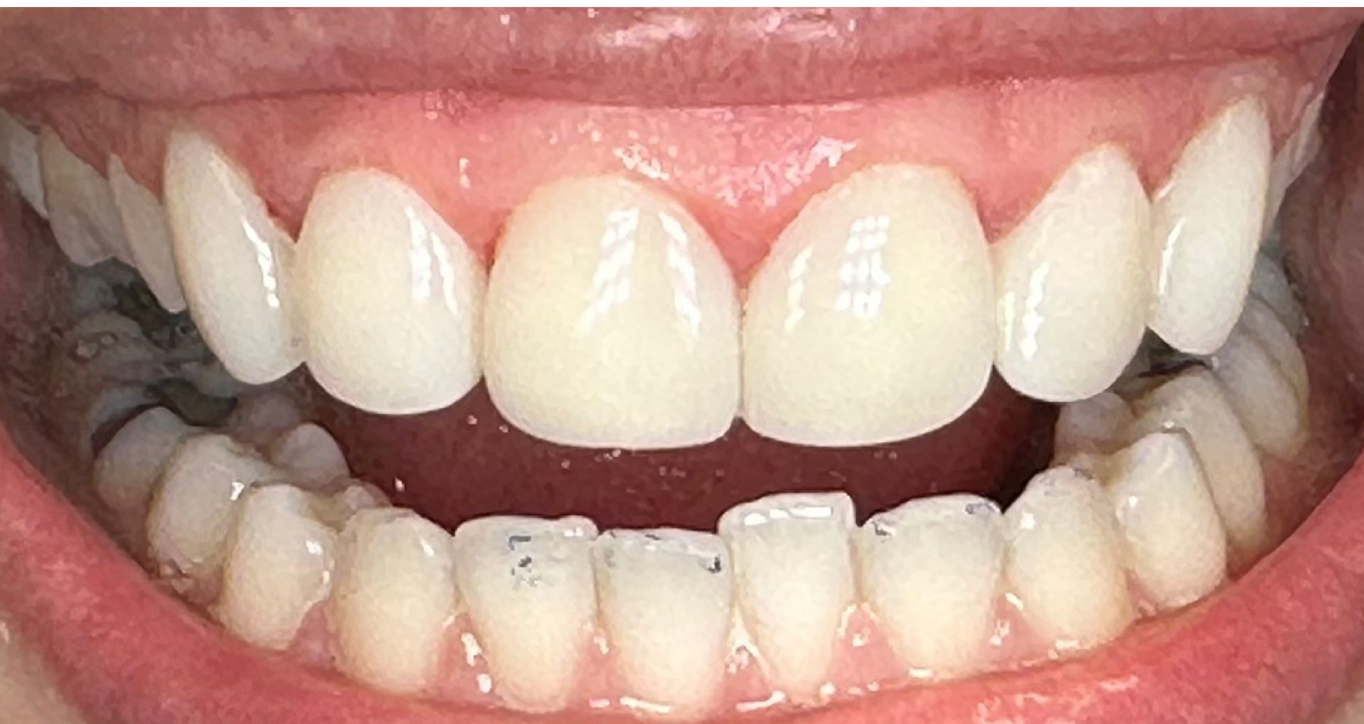 Close-up of an open mouth showing upper and lower teeth, some with dental work, against pink gums.