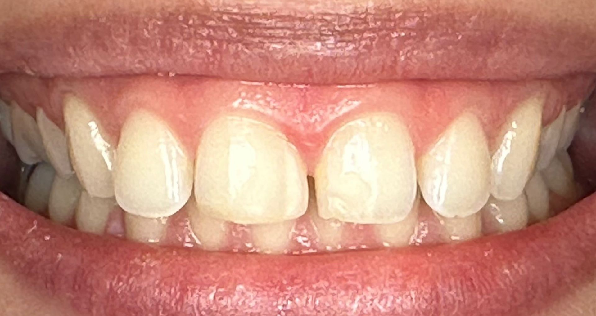 Close-up of teeth showing a gap between the top front teeth.