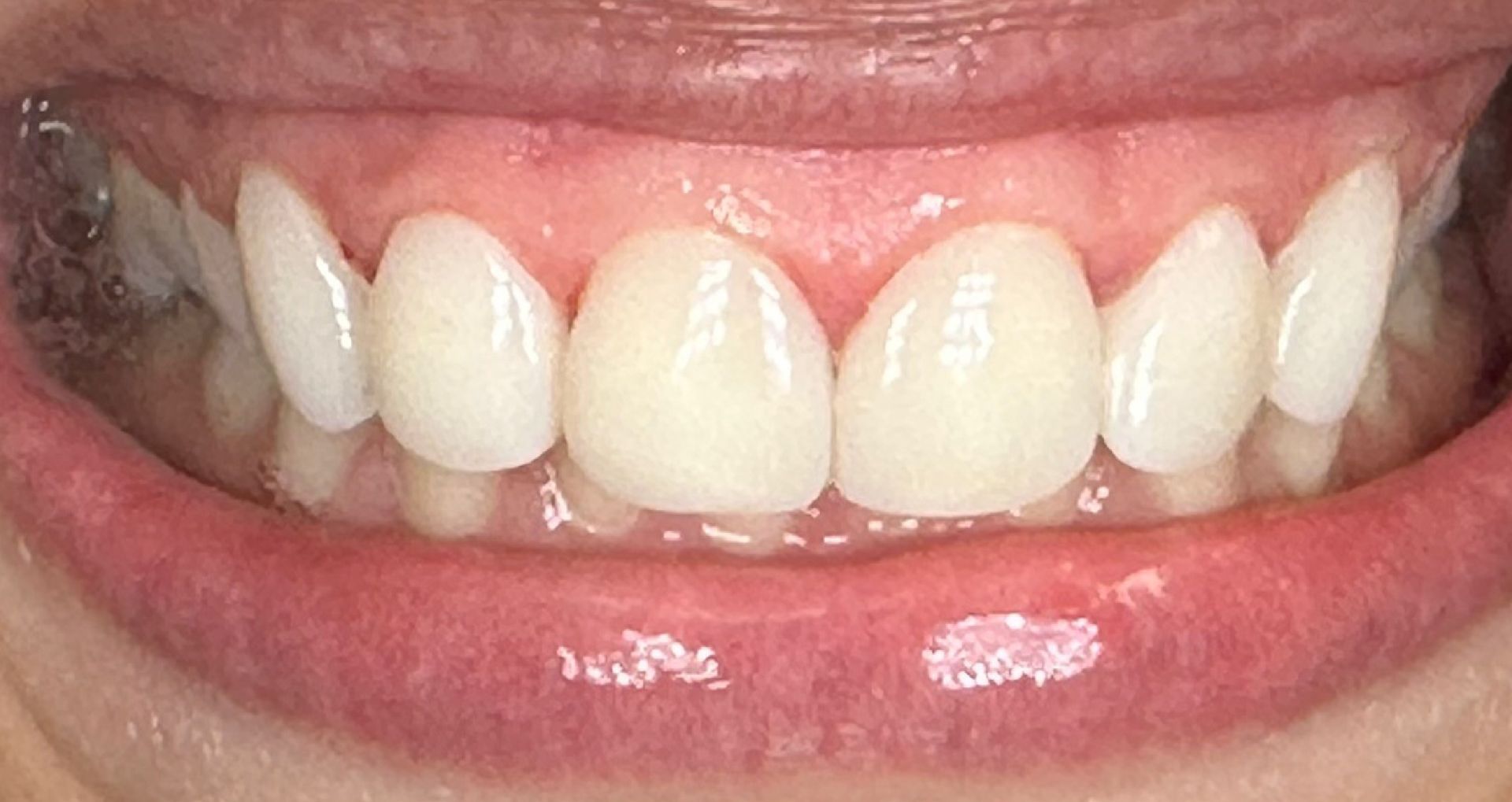 Close-up of teeth showing uneven wear and slight misalignment; mostly white with pink gums.
