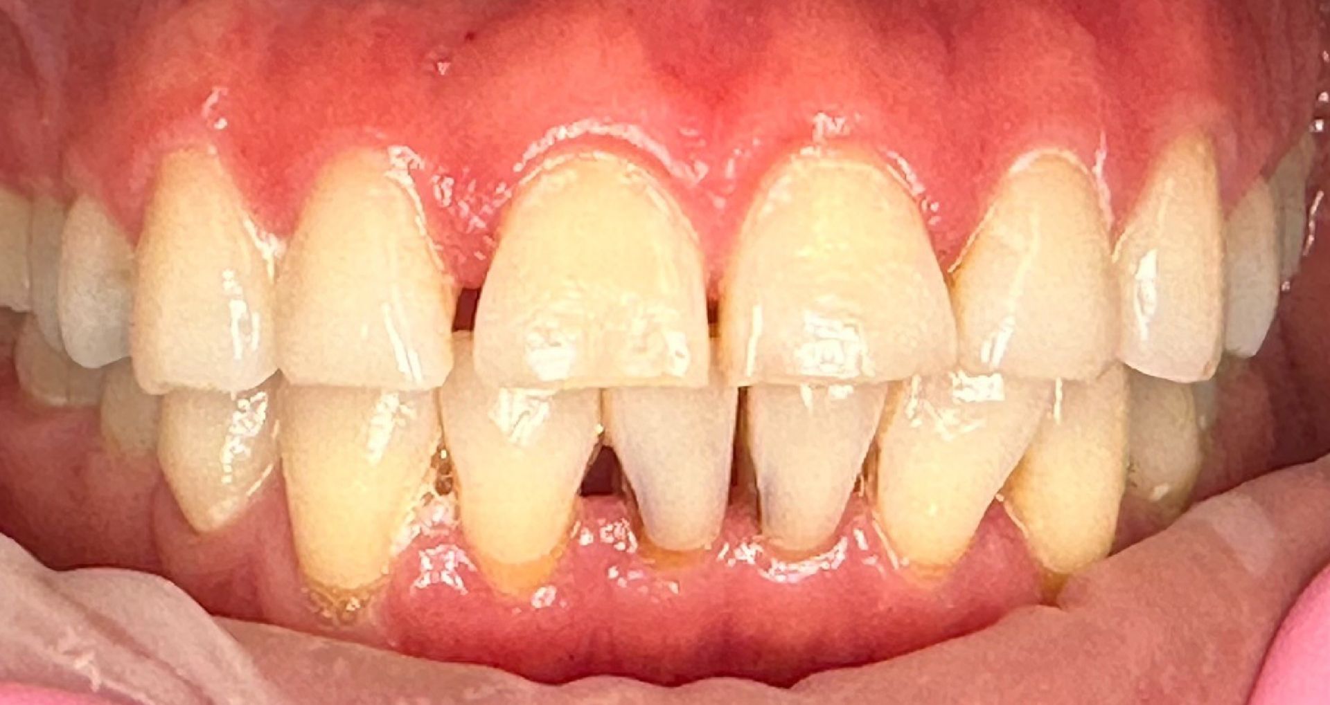 Close-up of a smile showing discolored and chipped front teeth.