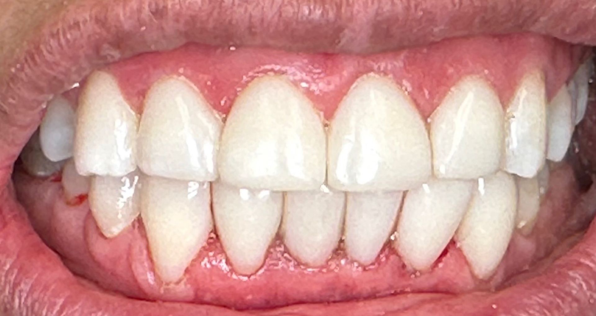 Close-up of a smiling person's teeth, showing a gap between the front teeth, pink gums, and red lips.
