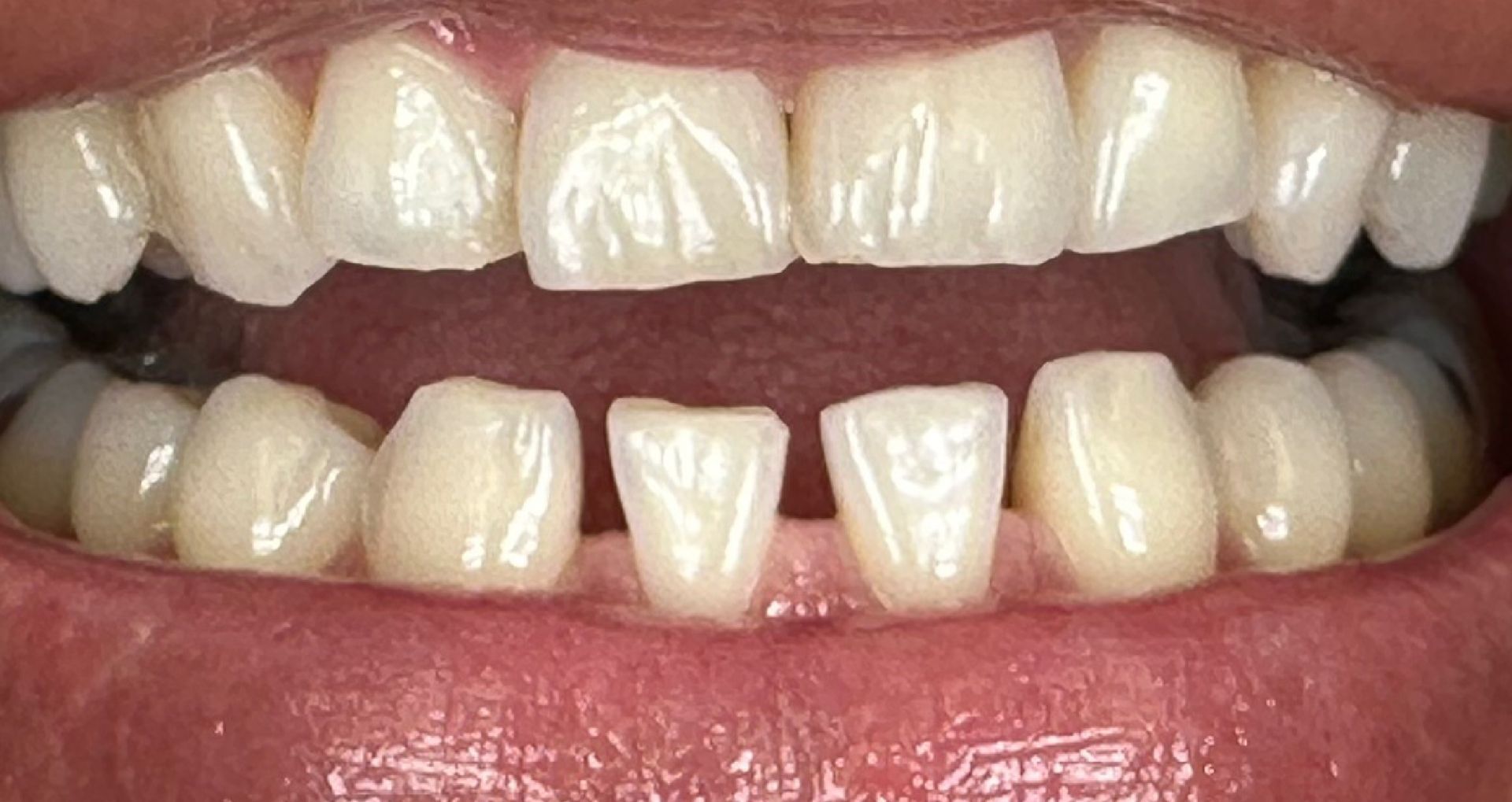 Close-up of a person's teeth showing a gap between the front teeth, and a pink gum line.