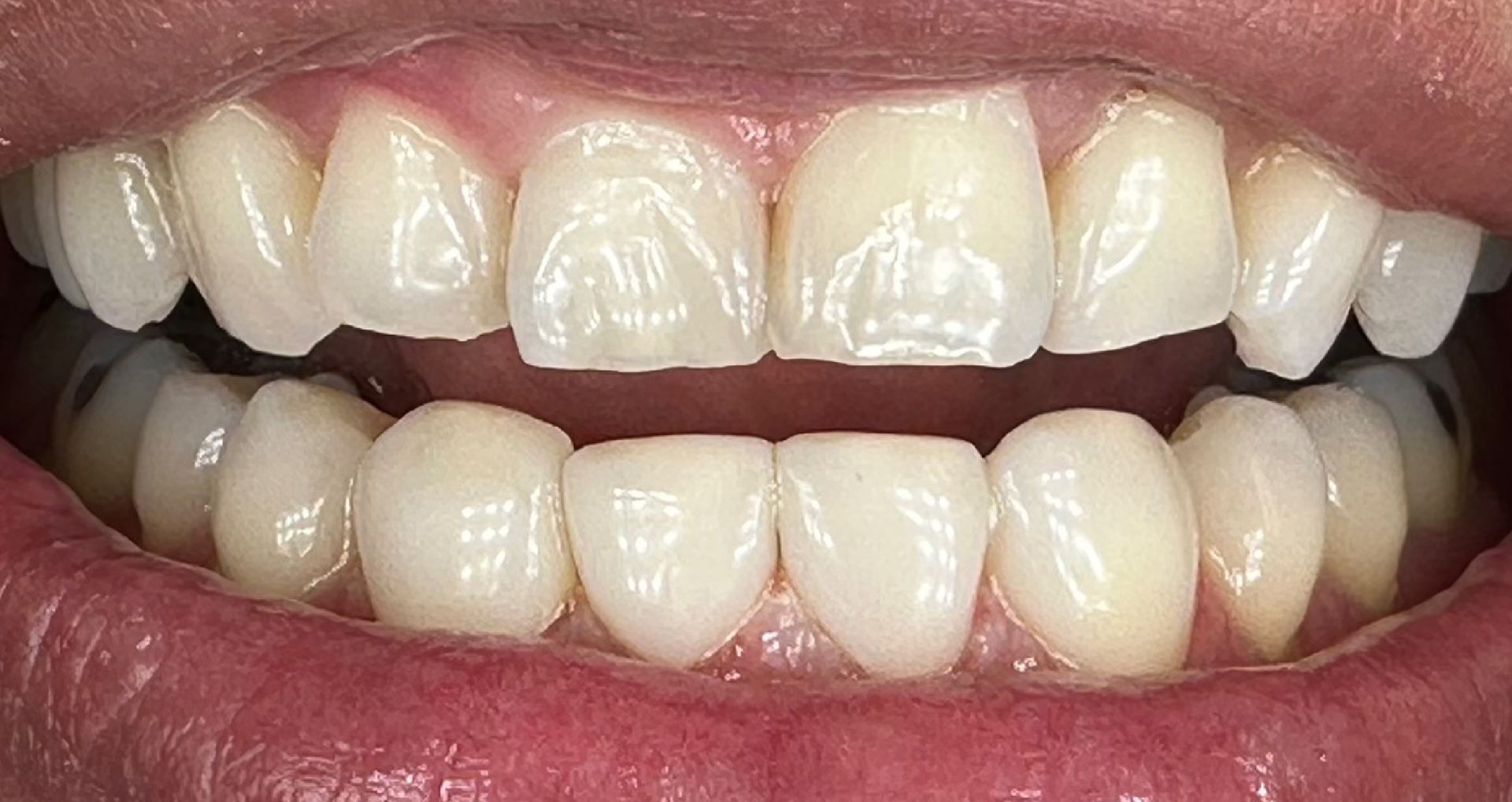 Close-up of an open mouth showing upper and lower teeth, some with dental work, against pink gums.