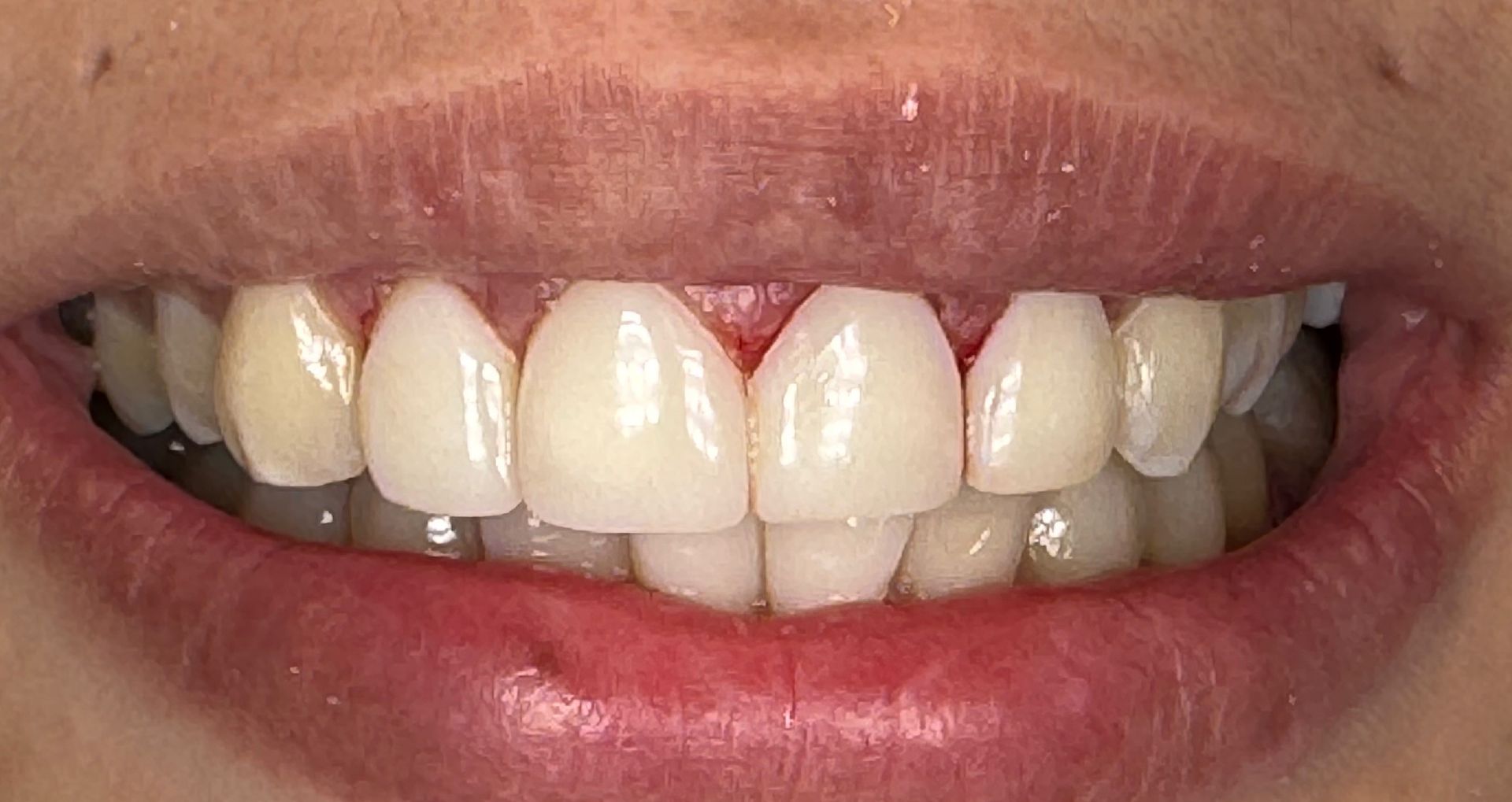 Close-up of an open mouth showing upper and lower teeth, some with dental work, against pink gums.