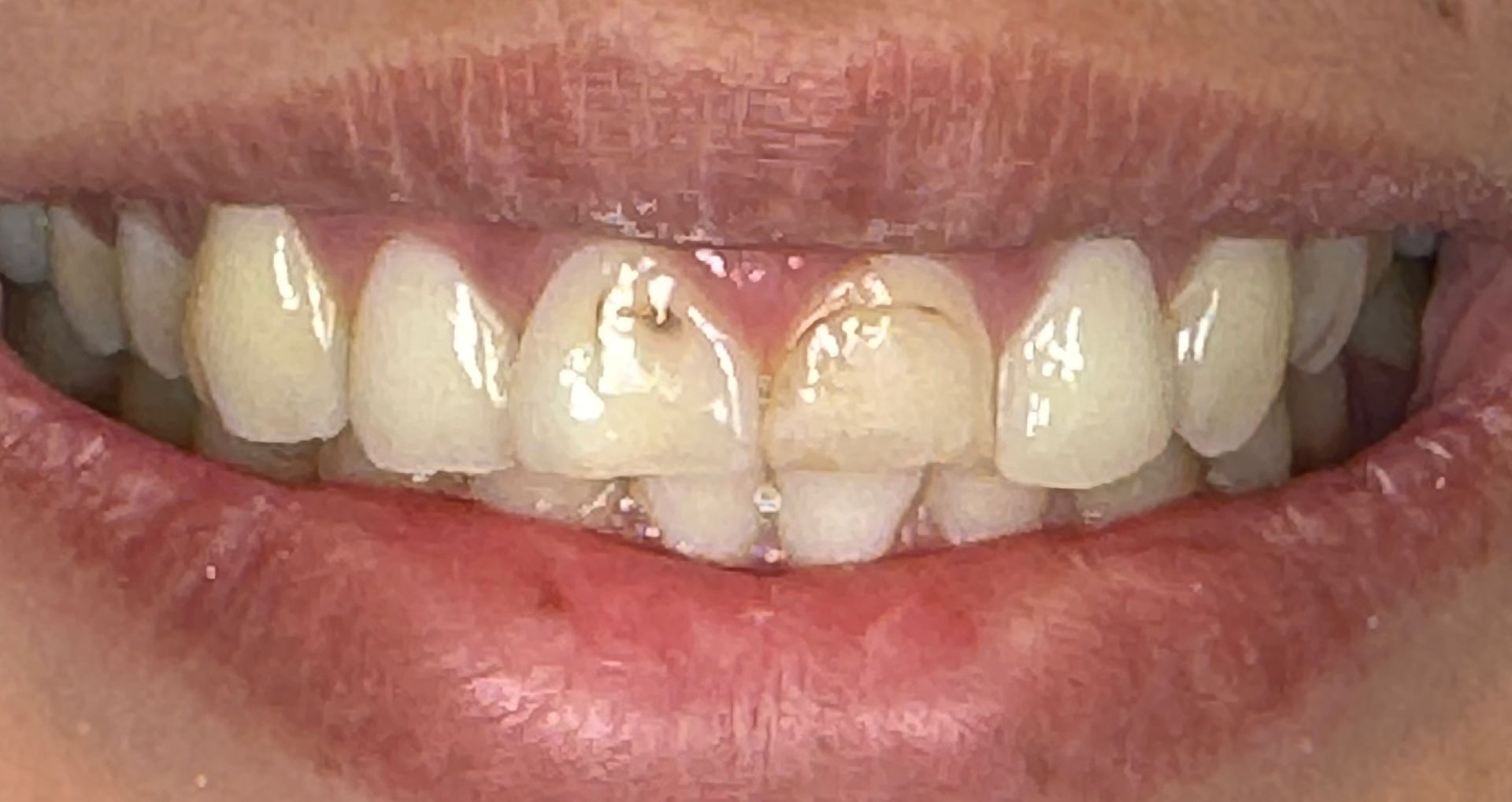 Close-up of a person's teeth showing a gap between the front teeth, and a pink gum line.