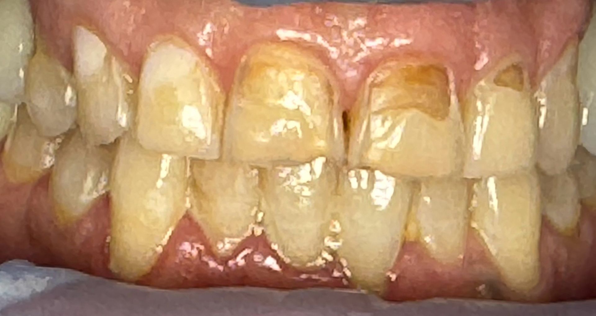 Close-up of teeth showing a gap between the top front teeth.
