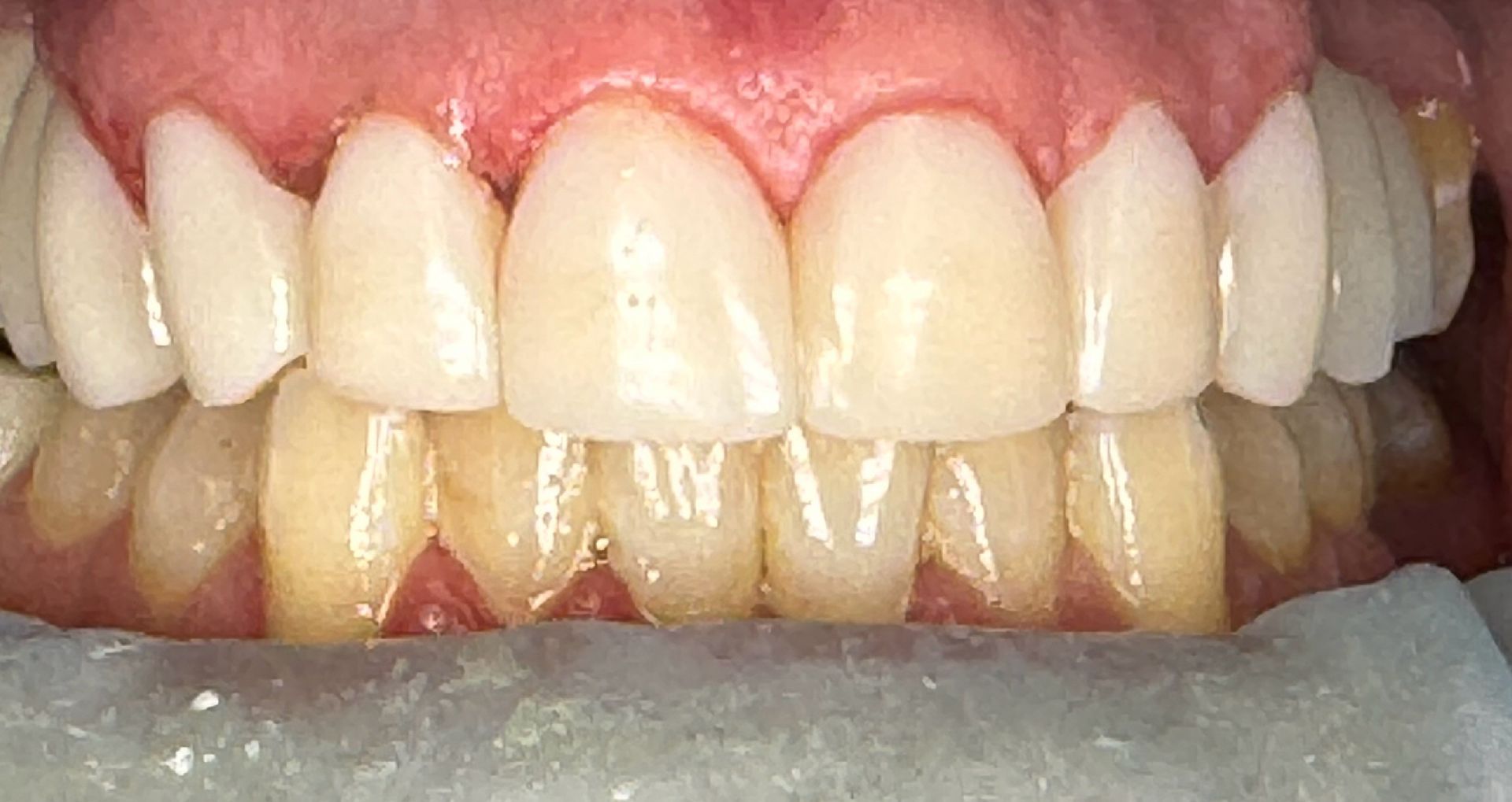 Close-up of teeth showing uneven wear and slight misalignment; mostly white with pink gums.