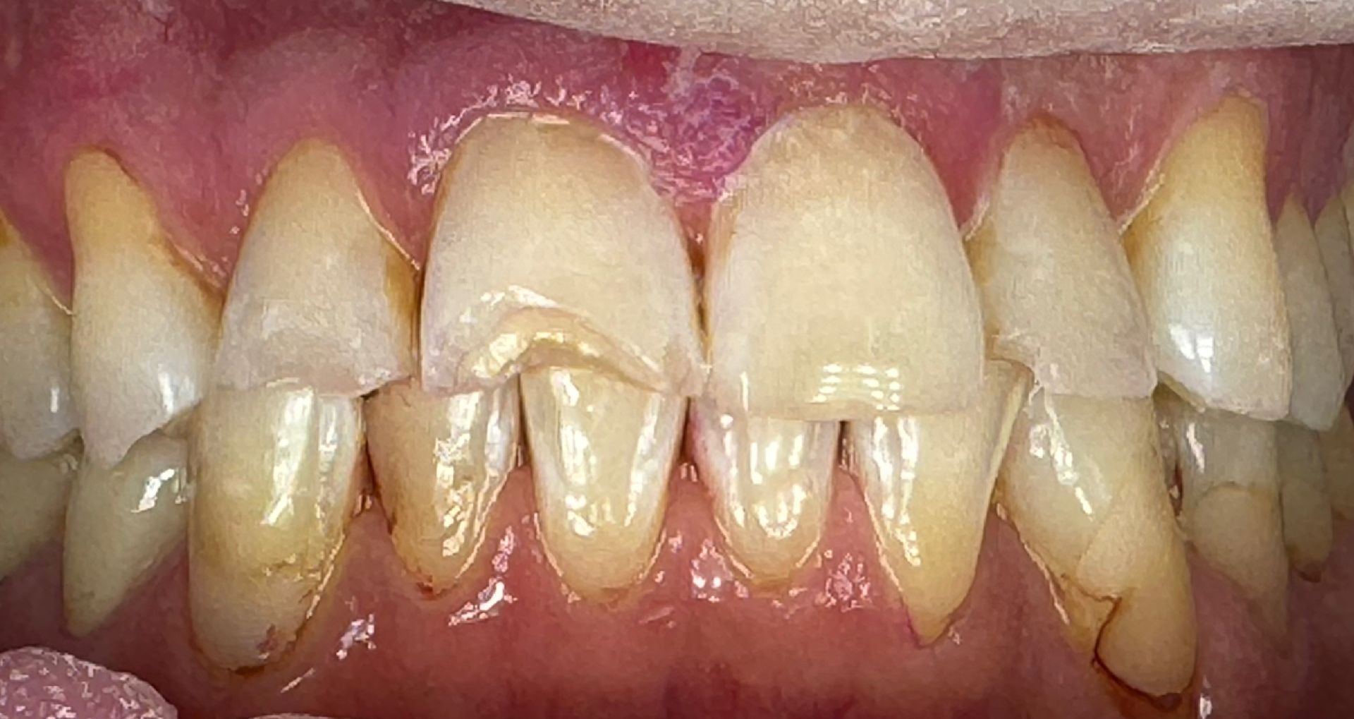 Close-up of a smile showing discolored and chipped front teeth.