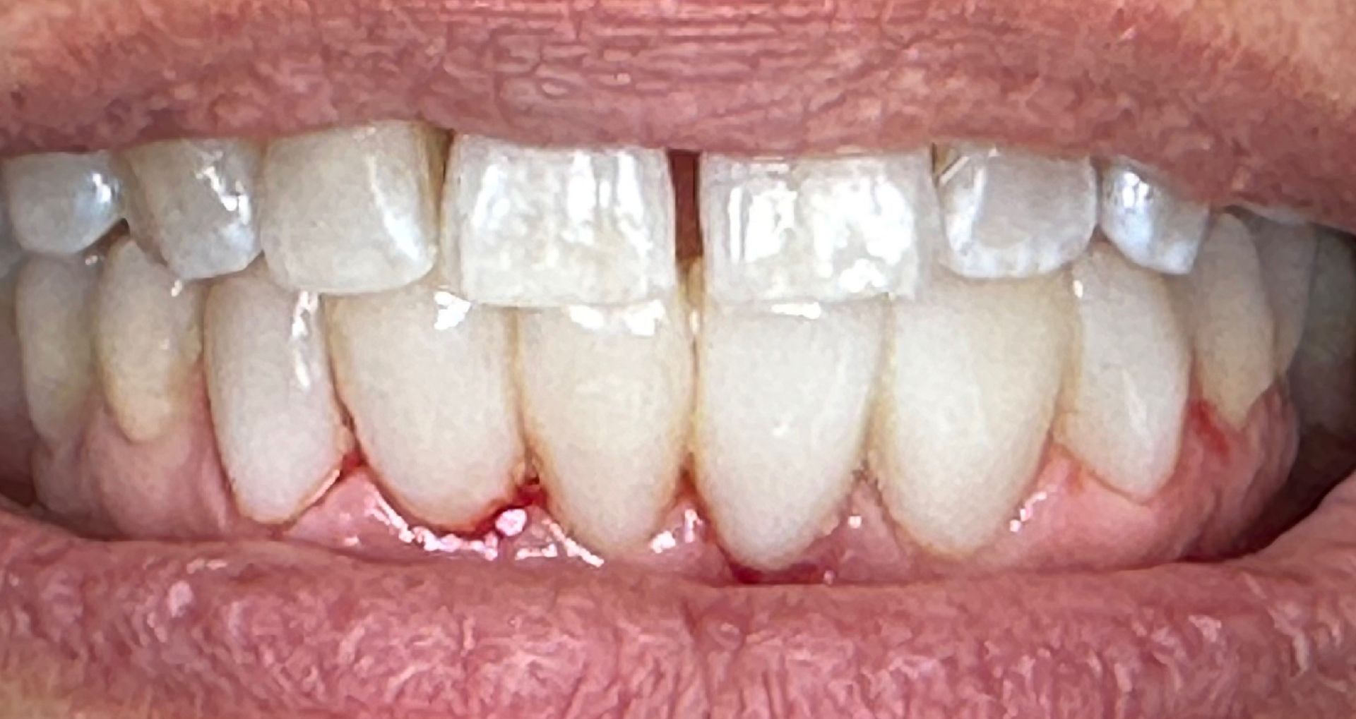 Close-up of an open mouth showing upper and lower teeth, some with dental work, against pink gums.