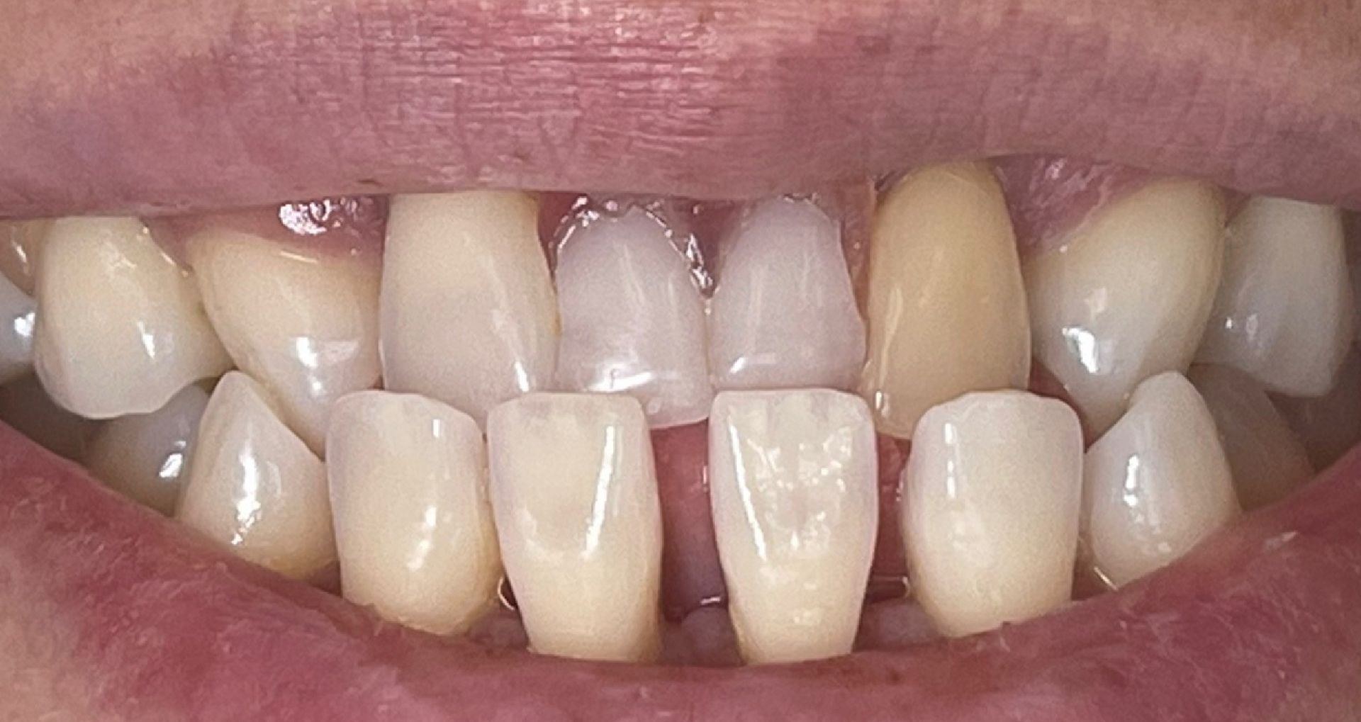 Close-up of teeth showing a gap between the top front teeth.