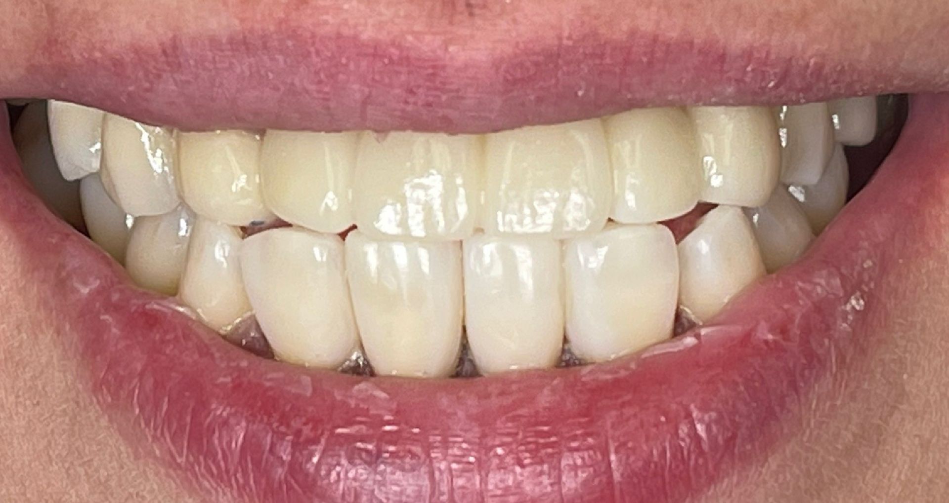 Close-up of teeth showing uneven wear and slight misalignment; mostly white with pink gums.