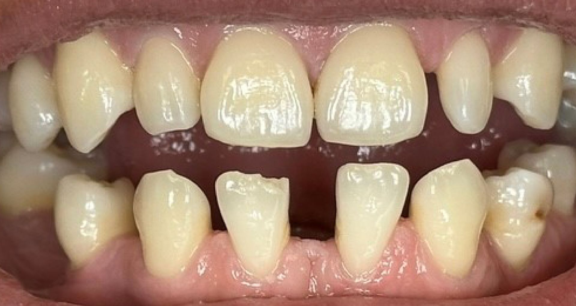 Close-up of teeth showing a gap between the top front teeth.