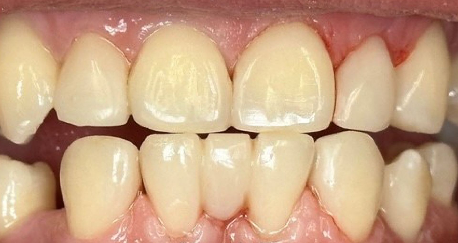 Close-up of teeth showing uneven wear and slight misalignment; mostly white with pink gums.