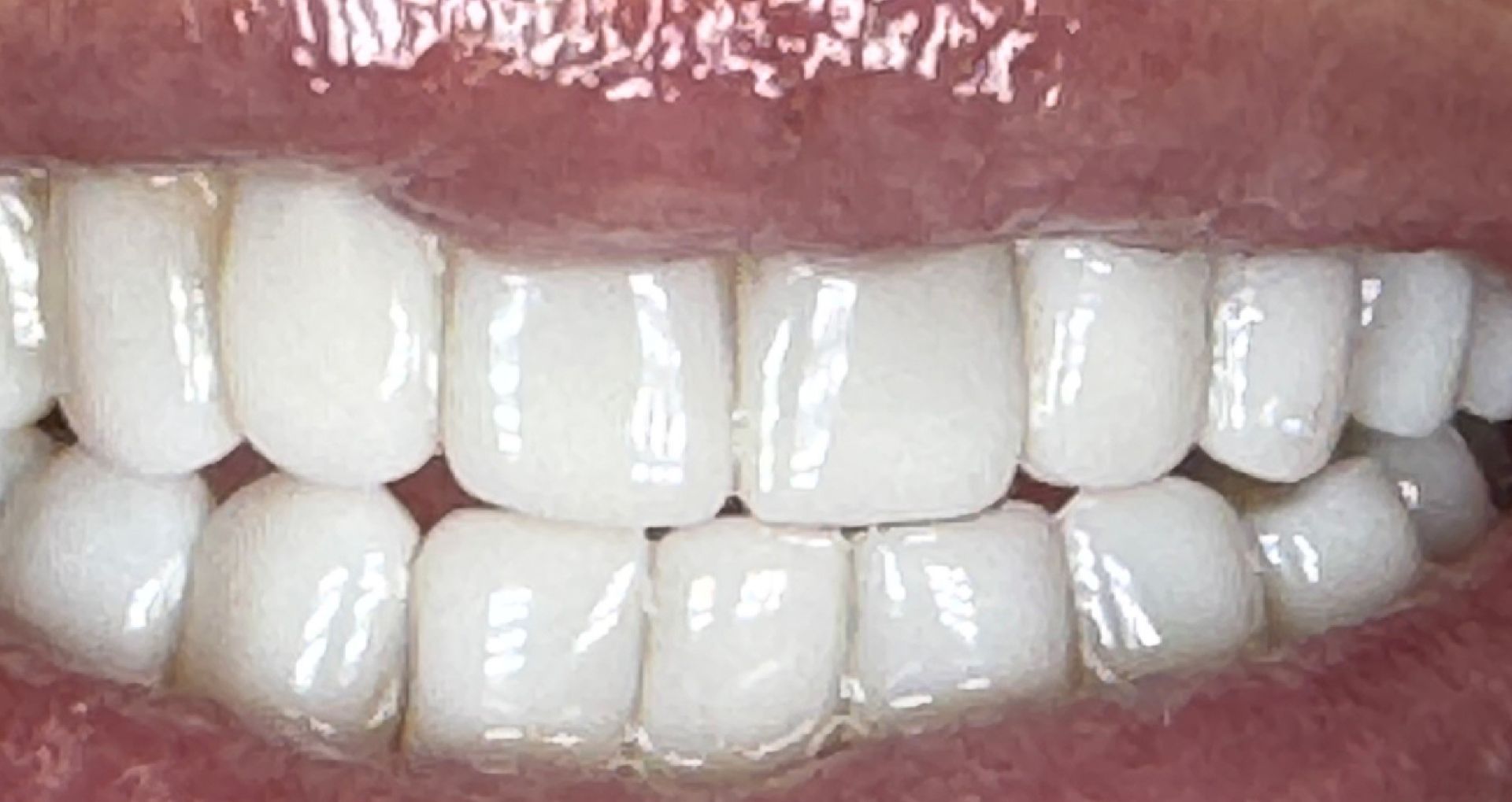 Close-up of teeth showing uneven wear and slight misalignment; mostly white with pink gums.