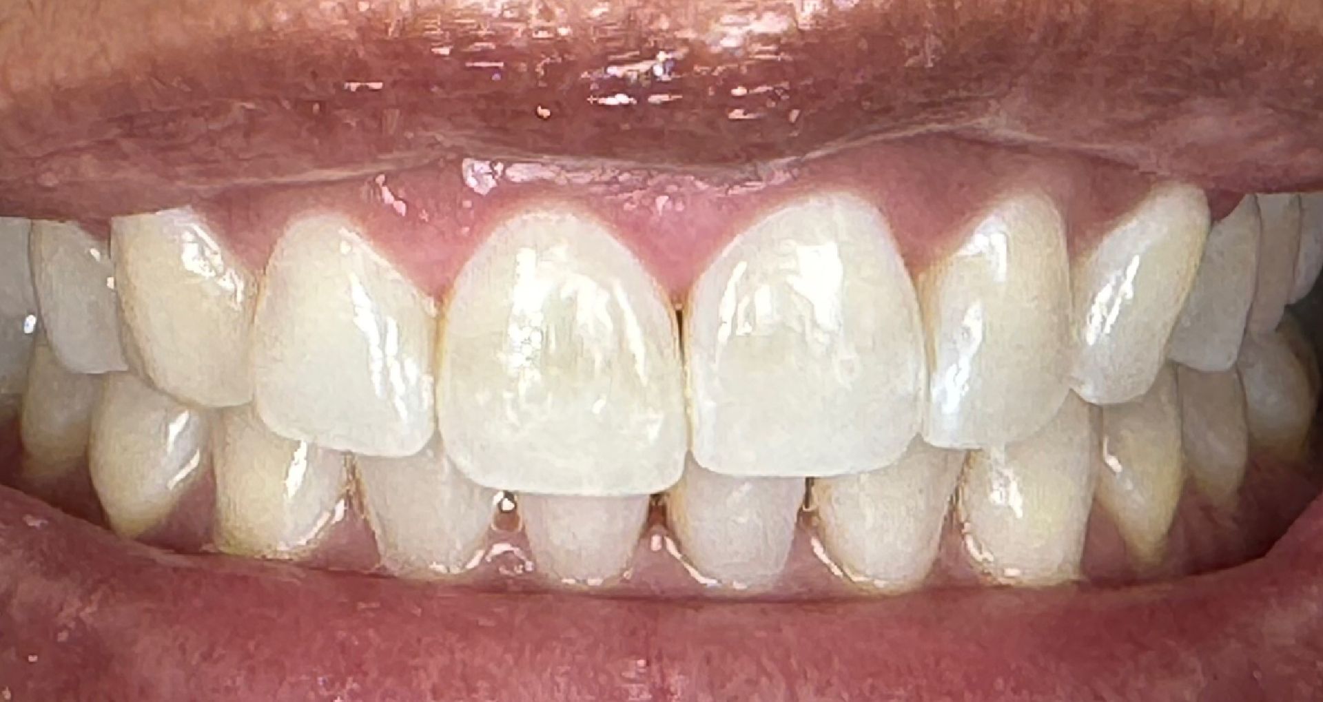 Close-up of teeth showing a gap between the top front teeth.