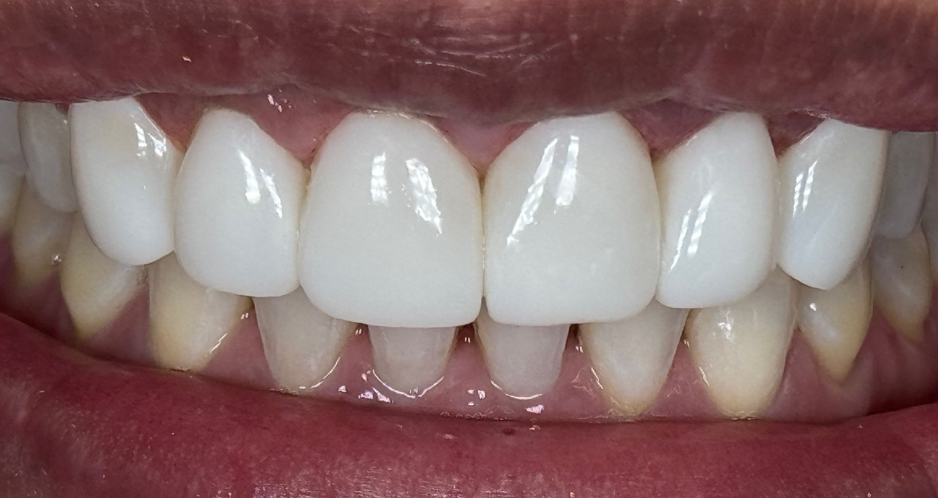 Close-up of teeth showing uneven wear and slight misalignment; mostly white with pink gums.