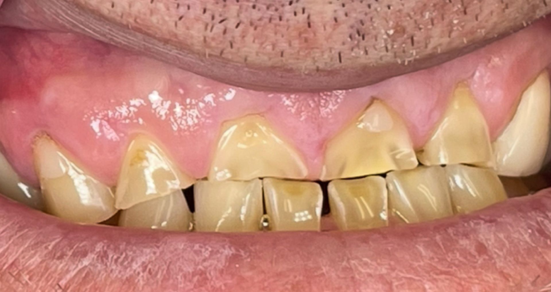 Close-up of teeth showing a gap between the top front teeth.