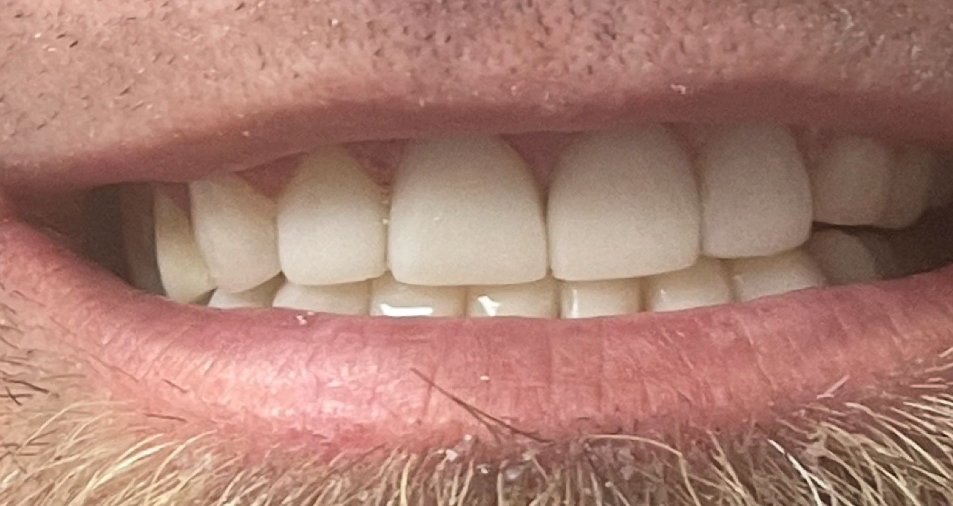 Close-up of teeth showing uneven wear and slight misalignment; mostly white with pink gums.
