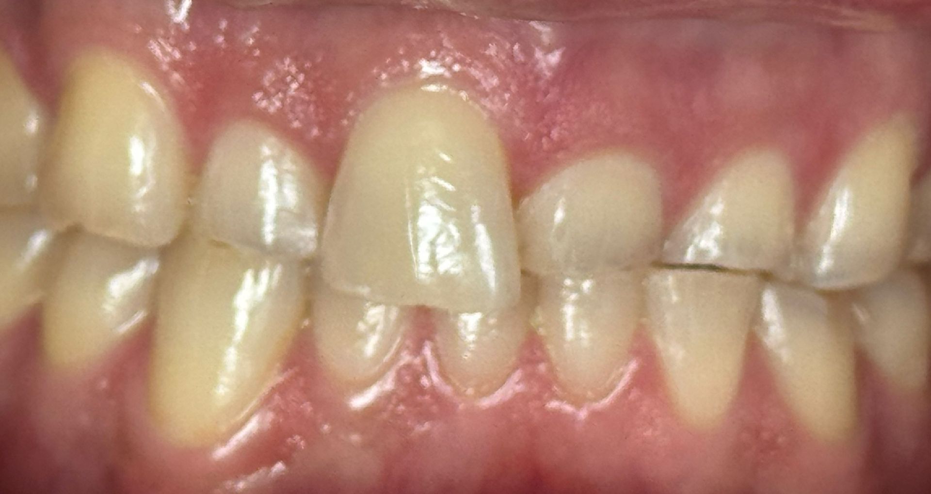 Close-up of teeth showing a gap between the top front teeth.