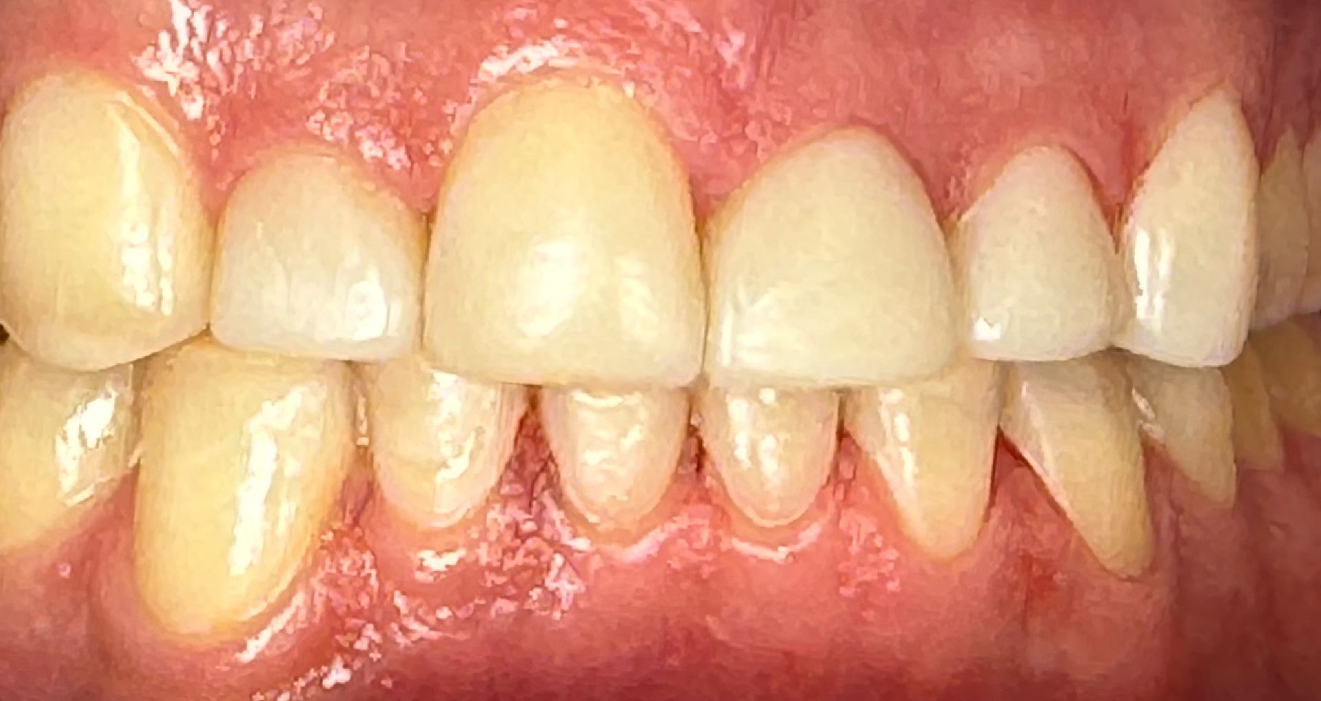Close-up of teeth showing uneven wear and slight misalignment; mostly white with pink gums.