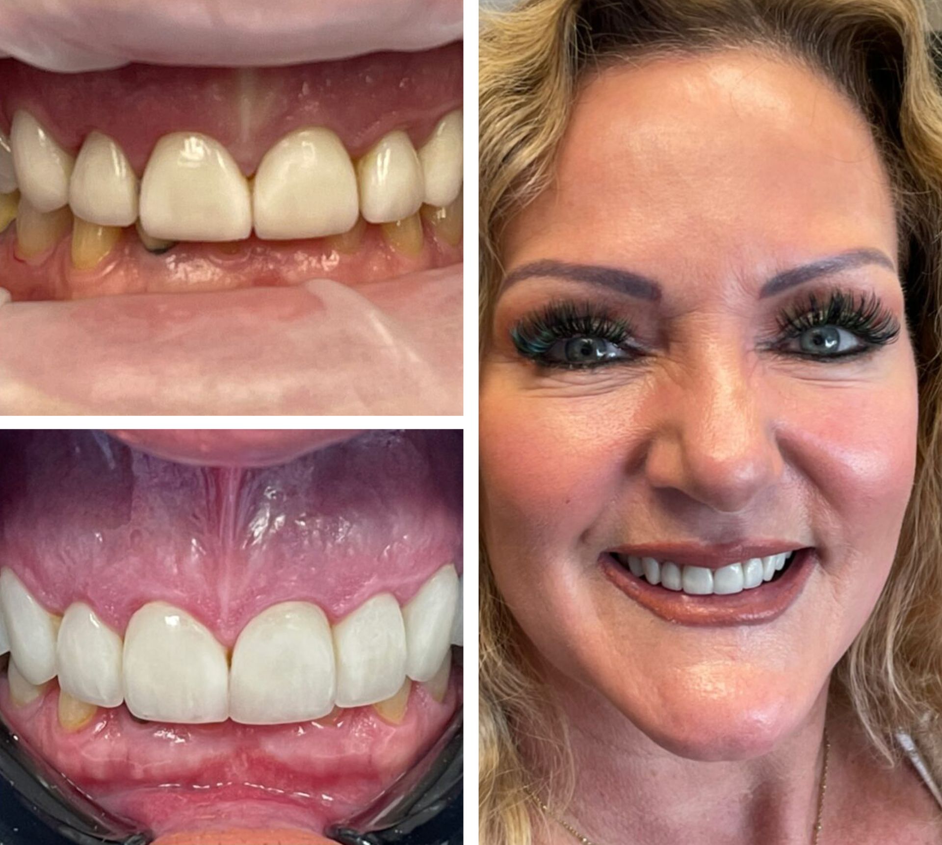 Dental work: Before and after teeth whitening with patient smiling.