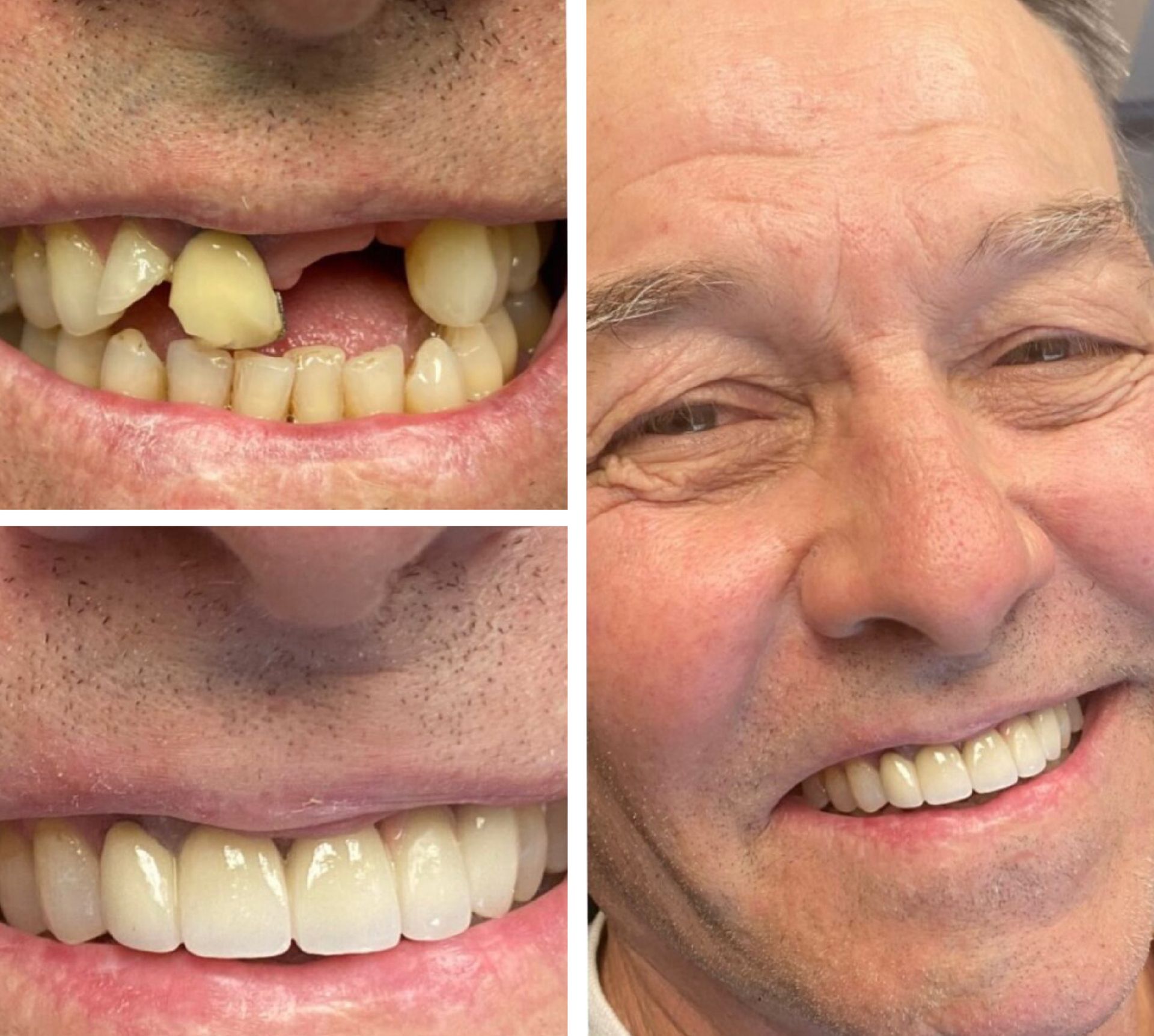 Before-and-after photos of a man's teeth: damaged teeth, then restored with a full set of bright, white teeth.