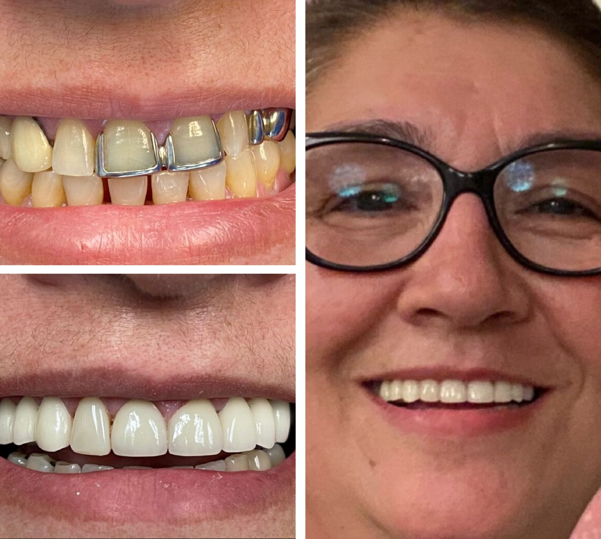 Side-by-side comparison: Before and after dental work. Bottom: person with a beautiful smile. Right: older woman wearing glasses.