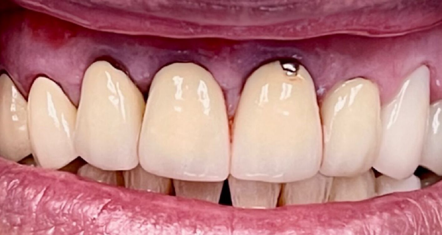 Close-up of mouth with teeth; a front tooth has a noticeable dark filling.