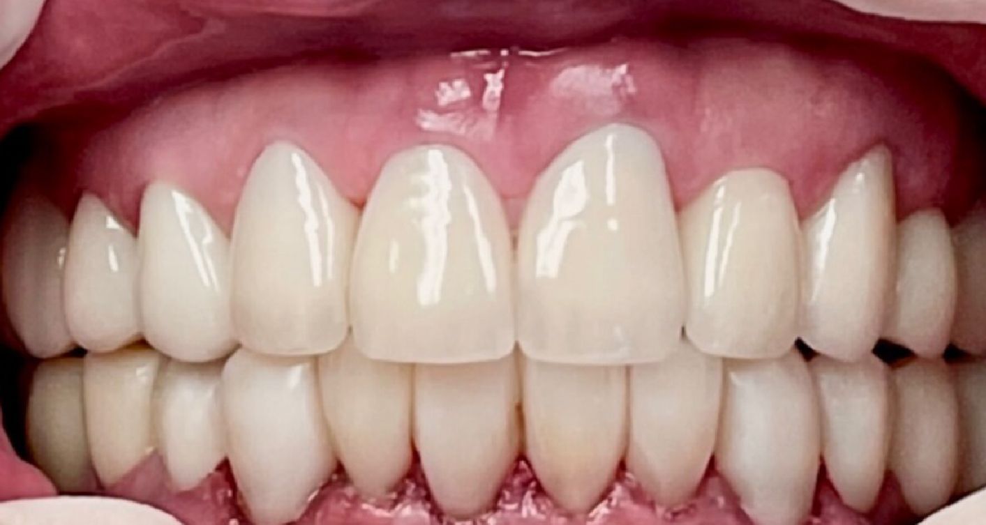 Close-up of bright, white, aligned teeth in pink gums, demonstrating a perfect smile.